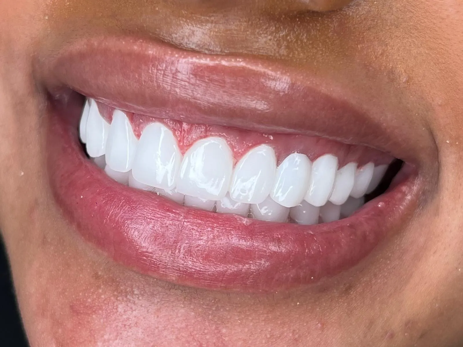 Turkey Smile Studio Tedavi #0002