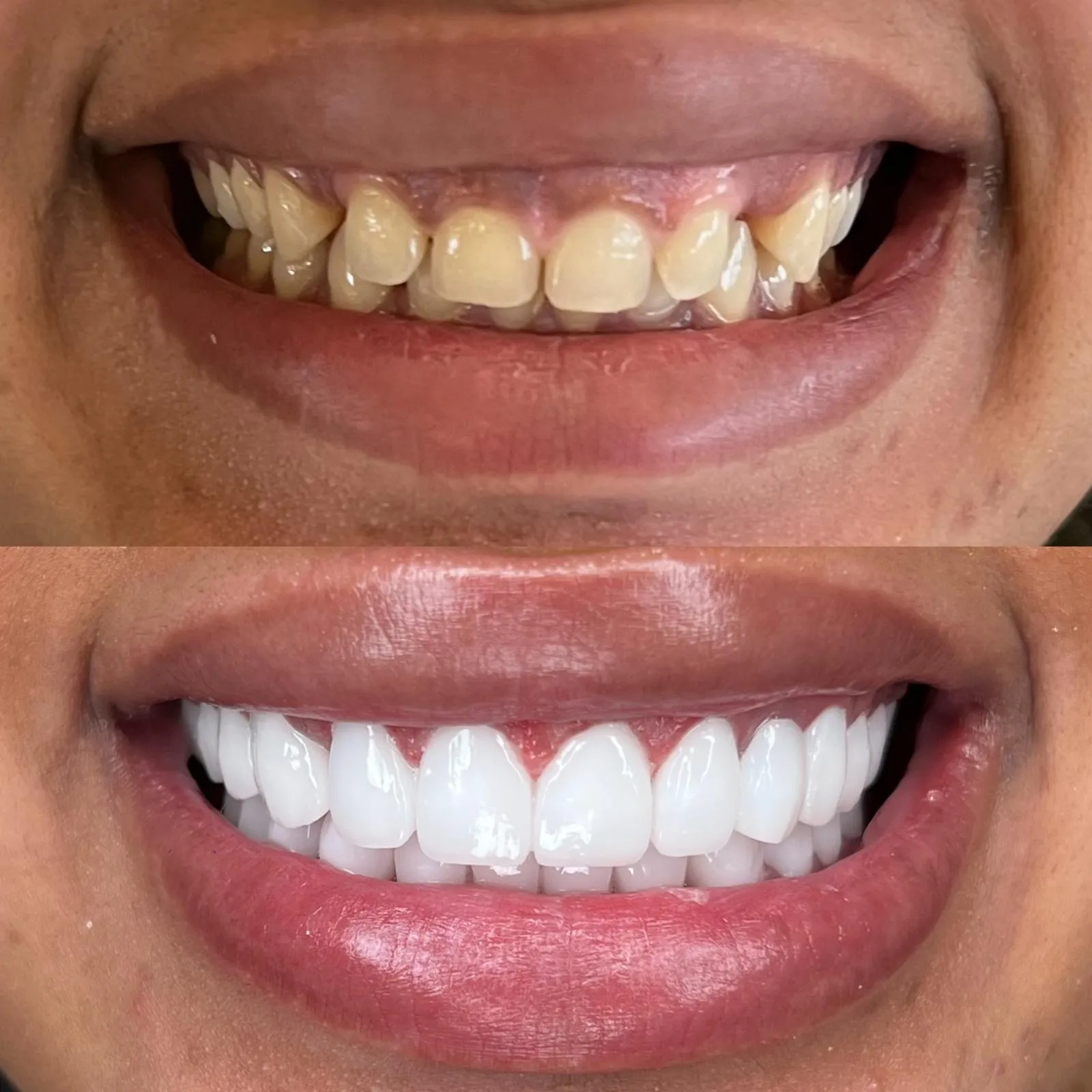 Turkey Smile Studio Tedavi #0002